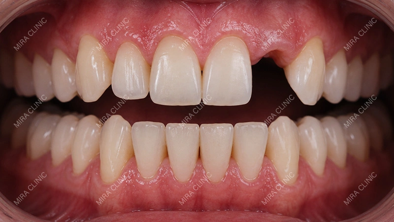 One Missing Tooth